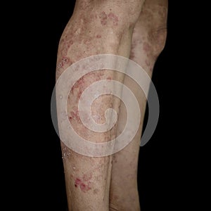 Fungal infection called tinea corporis in leg of Asian woman