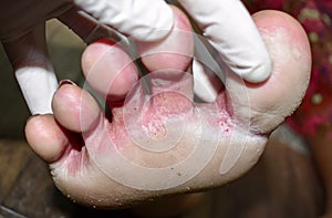 Fungal infection called tinea pedis at foot of Asian woman