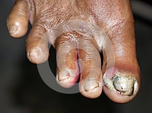 Fungal infection called tinea pedis and paronychia at toes photo