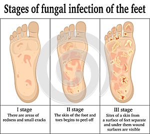 Fungal infection on the feet