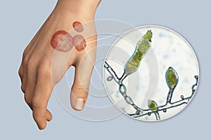 Hand fungal infection, tinea manuum, 3D illustration