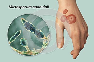 Hand fungal infection, tinea manuum, 3D illustration