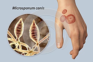 Hand fungal infection, tinea manuum, 3D illustration