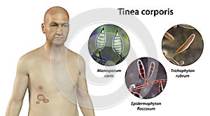 Fungal infection on a man's body. Tinea corporis, 3D illustration