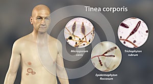 Fungal infection on a man's body. Tinea corporis, 3D illustration