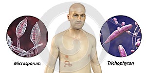 Fungal infection on a man's body. Tinea corporis, 3D illustration