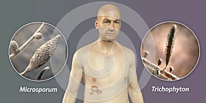 Fungal infection on a man's body. Tinea corporis, 3D illustration