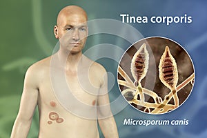 Fungal infection on a man's body. Tinea corporis, 3D illustration