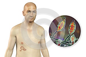 Fungal infection on a man's body. Tinea corporis, 3D illustration