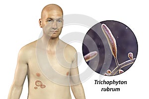 Fungal infection on a man's body. Tinea corporis, 3D illustration