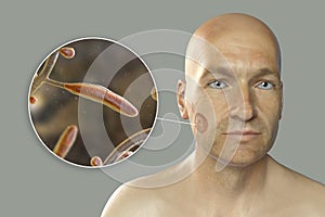 Fungal infection on a man's face, 3D illustration