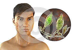 Fungal infection on a man's face, 3D illustration. Tinea faciei, caused by fungi Microsporum canis, Trichophyton rubrum, T.