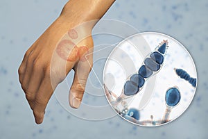 Fungal infection on a man's hand. Tinea manuum and close-up view of dermatophyte fungi