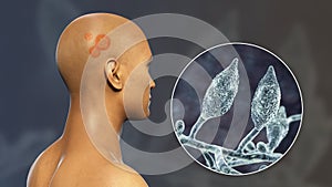Fungal infection on a man's head, 3D illustration