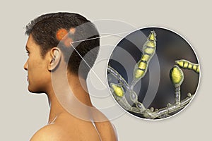 Fungal infection on a man's head, 3D illustration