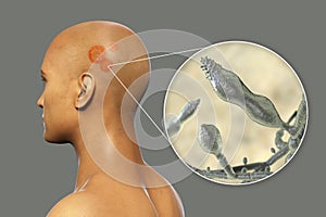 Fungal infection on a man's head, 3D illustration