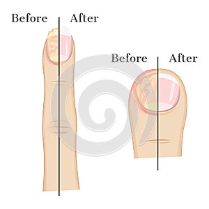 Fungal infection of the nail