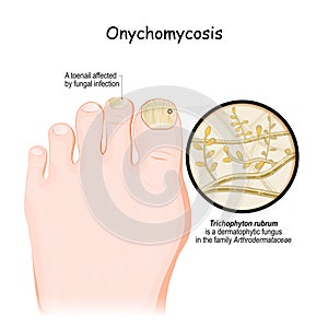 Fungal infection of the nail. close-up of A toenail affected by dermatophytic fungus