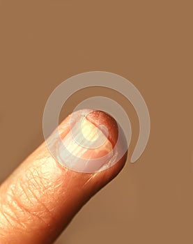 Fungal infection under the nail. A finger on a hand with a fungal infection of the nail.