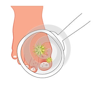 Fungal infections of nails. Vector illustration of skin diseases