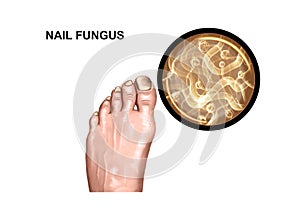 Fungal lesion of the foot