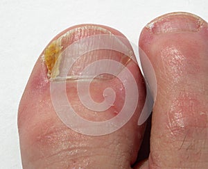 Fungal Nail Infection on big toe