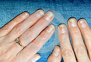 Fungal nail infection, onycholysis after shellac or gel-varnish.