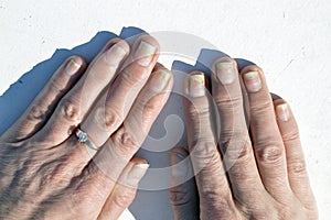 Fungal nail infection, onycholysis after shellac or gel-varnish. Isolated on white background. photo