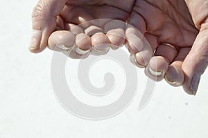 Fungal nail infection, onycholysis after shellac or gel-varnish. Isolated on white background. photo