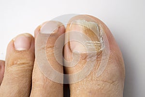 Fungal nail infection photo