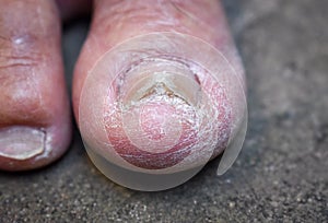 Fungal nail infection. Onychomycosis, also called Tinea unguium