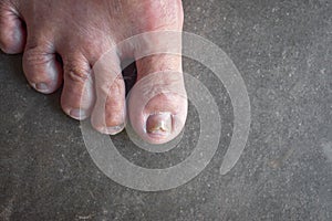 Fungal nail infection. Onychomycosis, also called Tinea unguium. Dry big toe