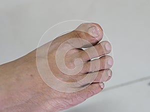 Fungal Nail Infection Onychomycosis Tinea Unguium