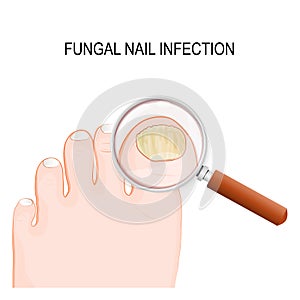 Fungal nail infection photo