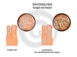 Fungal nail lesion photo