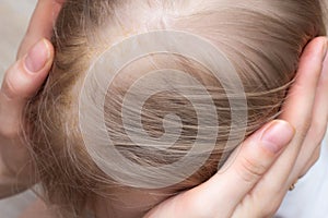 Fungal skin disease seborrheic dermatitis in a child`s head, close-up, seborrhea crust, dermatology