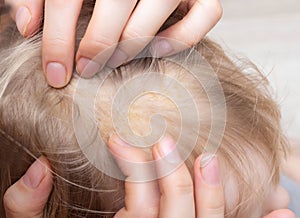 Fungal skin disease seborrheic dermatitis in a child`s head, close-up, seborrhea crust, dermatology photo