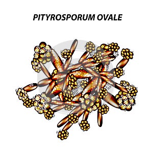 Fungal yeast pathogen seborrhea Pityrosporum ovale Malassezia furfur. Seborrhea skin and hair. Dandruff, seborrheic