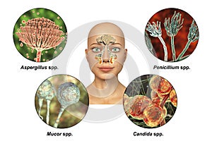 Fungi as a cause of sinusitis. 3D illustration showing inflammation of maxillary sinuses and close-up view of fungi