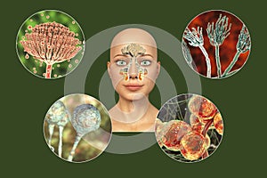 Fungi as a cause of sinusitis. 3D illustration showing inflammation of maxillary sinuses and close-up view of fungi