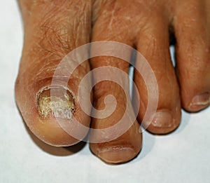 Fungus on the big toe. Fungal disease on the nail psoriasis