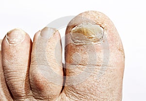 Fungus infection on nails