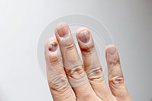 Fungus Infection on Nails Hand, Finger with onychomycosis. - soft focus photo