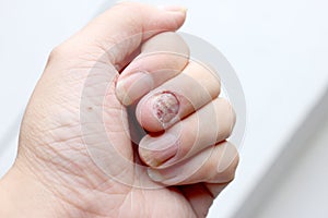 Fungus Infection on Nails Hand, Finger with onychomycosis. - soft focus photo