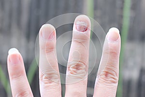 Fungus Infection on Nails Hand, Finger with onychomycosis. - soft focus