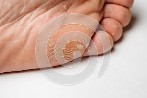 Fungus Infection on Nails of Man& x27;s Foot on white background
