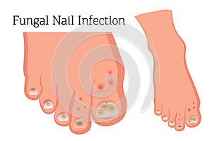 Fungus on nails, diseases of the skin of the feet