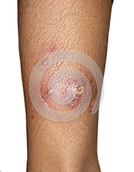 Furuncles or staphylococcal infection in leg of Asian child