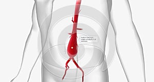 Fusiform aneurysm, bulges out equally in all directions