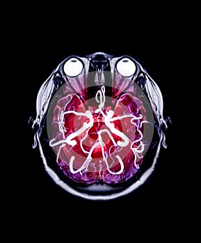 Fusion image of MRI brain and MRA Brain.